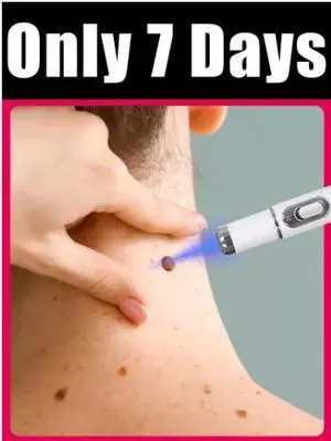 Portable Blue Light Wart Removal Device - Laser Treatment for Clear Skin Portable Blue Light Wart Removal Device - Laser Treatment for Clear Skin