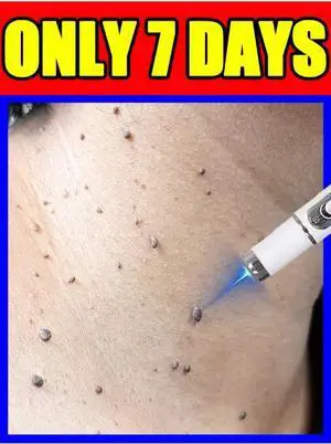7 day Best-Selling Blue Light Pen: Effective for Body Wart Removal & Wart Care 7 day Best-Selling Blue Light Pen: Effective for Body Wart Removal & Wart Care