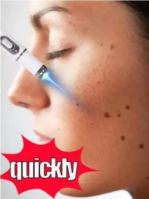 New nano laser device for high-quality skin care for freckle and mole removal New nano laser device for high-quality skin care for freckle and mole removal