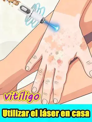 Vitiligo blue light pen,2026 hot sale,Vitiligo care tools,unisex,Generation-2,Combination Set Meals Vitiligo blue light pen,2026 hot sale,Vitiligo care tools,unisex,Generation-2,Combination Set Meals