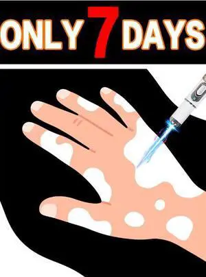 Blue light pen solve Vitiligo,2026 NEW hot sale leg care tools Blue light pen solve Vitiligo,2026 NEW hot sale leg care tools