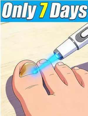 Nail Treatment Laser Pen Painless Anti Fungus Infection Fungal Removal Laser Onychomycosis Care Strong Grow Toe Nail Repair Tool Nail Treatment Laser Pen Painless Anti Fungus Infection Fungal Removal Laser Onychomycosis Care Strong Grow Toe Nail Repair Tool