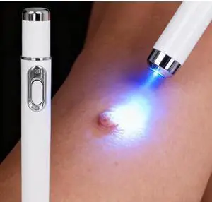 Wart care tools, blue light pen, warts, 2026 hot sale Wart care tools, blue light pen, warts, 2026 hot sale