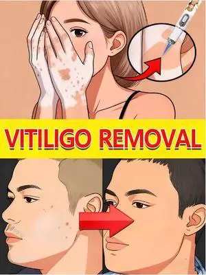 blue light pen solve Vitiligo, hot sale wart care tools blue light pen solve Vitiligo, hot sale wart care tools