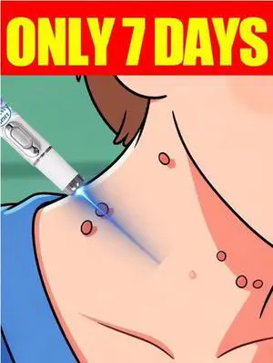Blue Light Pen Midimum Strength Common and Plantar Wart Falling off warts care tool Blue Light Pen Midimum Strength Common and Plantar Wart Falling off warts care tool