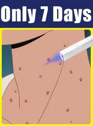 Blue Light Laser Pen Non-Invasive Filiform Flat Wart Removal Skin Smoothing Tool Blue Light Laser Pen Non-Invasive Filiform Flat Wart Removal Skin Smoothing Tool