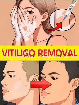 2026 Laser pen for removing white spots, a popular skin care tool, offers you a comfortable experience 2026 Laser pen for removing white spots, a popular skin care tool, offers you a comfortable experience