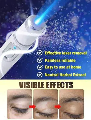 Generation-2 Blue light pen Says Goodbye To all Vitiligo In 7 Days Generation-2 Blue light pen Says Goodbye To all Vitiligo In 7 Days