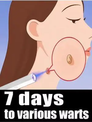 Wart removal solution for use in beauty salons, Skin Care Pen for Local Skin on Face and Body Wart removal solution for use in beauty salons, Skin Care Pen for Local Skin on Face and Body