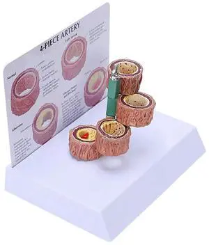 3X Atherosclerosis Thrombosis Model Vascular Disease Demonstration Heart Vascular Pathology Model