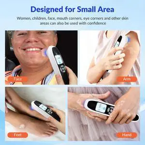 Toponechoice 308nm Laser Psoriasis 6pcs Blue Light Therapy For Rosacea Benefits of uv Light on Skin Eczema Infectious Skin Disease