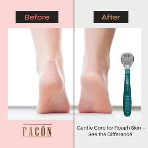 Professional Callus Shaver Remover with 50 Blades, Pedicure Razor for Feet & Hands, Foot Razor for Callus Removal, Callus Blade Remover, Corn Shaver, Surgical Grade Premium Stainless Steel Tool Professional Callus Shaver Remover with 50 Blades, Pedicure Razor for Feet & Hands, Foot Razor for Callus Removal, Callus Blade Remover, Corn Shaver, Surgical Grade Premium Stainless Steel Tool