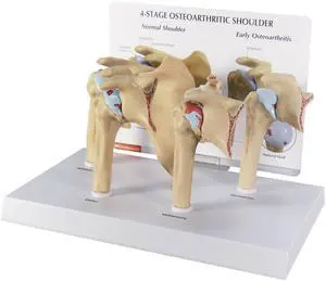 Shoulder Osteoarthritic (OA) 4-Stage Anatomical Model | Human Body and Anatomy Replica for Physiology Education, Anatomical Model for Doctor's Office, Medical Learning Resources Shoulder Osteoarthritic (OA) 4-Stage Anatomical Model | Human Body and Anatomy Replica for Physiology Education, Anatomical Model for Doctor's Office, Medical Learning Resources