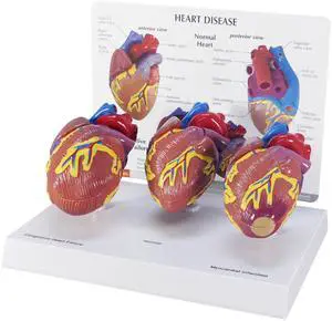 3-Piece Mini Heart Model Set, Normal and Diseased | Human Body and Anatomy Replica for Physiology Education, Anatomical Model for Doctor's Office, Medical Learning Resources 3-Piece Mini Heart Model Set, Normal and Diseased | Human Body and Anatomy Replica for Physiology Education, Anatomical Model for Doctor's Office, Medical Learning Resources