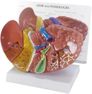 Liver Model with Common Pathologies | Human Body and Anatomy Replica for Physiology Education, Anatomical Model for Doctor's Office, Medical Learning Resources Liver Model with Common Pathologies | Human Body and Anatomy Replica for Physiology Education, Anatomical Model for Doctor's Office, Medical Learning Resources