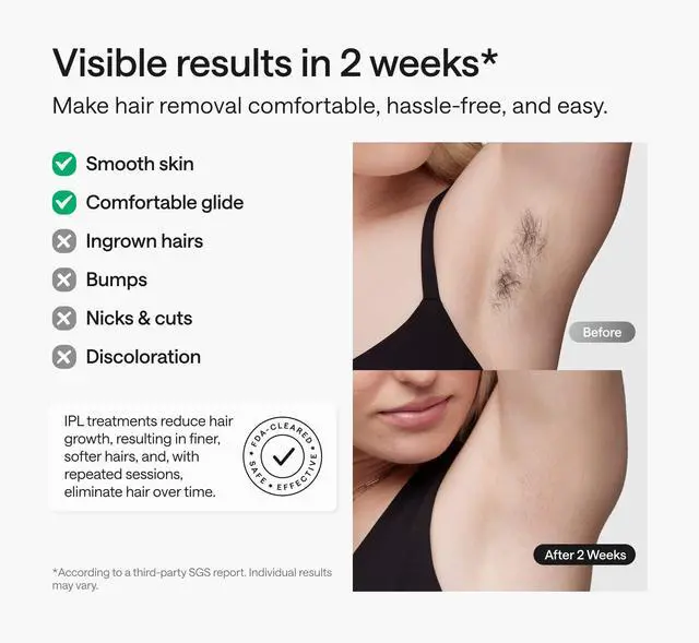 Alt view image 2 of 7 - Ulike PCUL5 Swift 5 Ice Cooling IPL Hair Removal Device