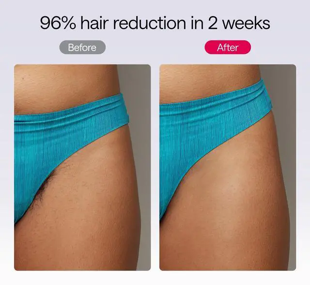 Alt view image 7 of 11 - Refurbished Ulike Air10 Ice Cooling IPL Hair Removal Device, RBUL10PU