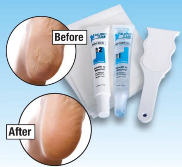 Alt view image 2 of 4 - Callous Clear Foot Treatment Kit Deluxe