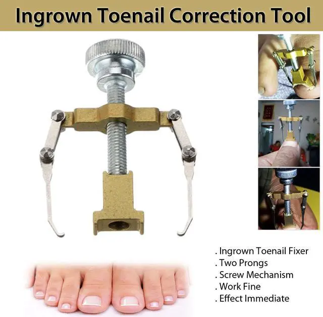 Alt view image 6 of 6 - Ingrown Toenail Correction Tool