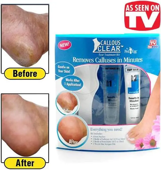 Alt view image 3 of 4 - Callous Clear Foot Treatment Kit