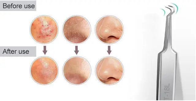 Alt view image 3 of 6 - BST-18L Blackhead Tweezers Eyelash Extension Nipper Anti Acid Steel Needle Tweezers Removal Acne Face Care Curved Straight Nail Tool