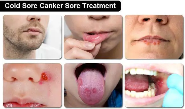 Alt view image 3 of 5 - COZING Red Light Cold Sore Therapy Cold Sore Canker Sore Treatment Device Infrared Red Light Therapy Device for Lips Mouth Nose Ear Body Patches Pain Relief