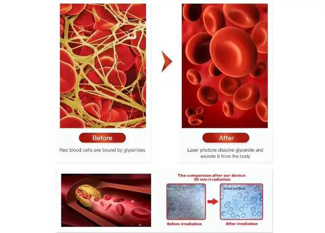 Alt view image 4 of 5 - 650nm laser therapeutic apparatus is suitable for patients with hyperlipidemia, cholesterol, vascular obstruction, hypertension, diabetes