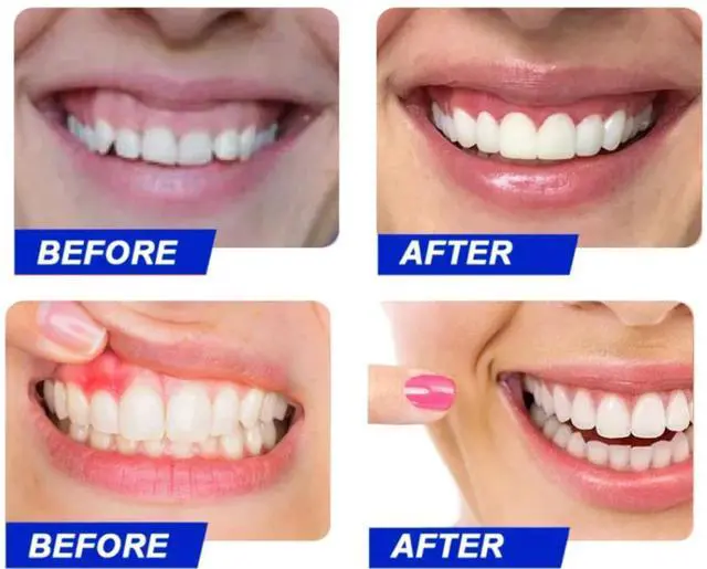 Alt view image 4 of 7 - Teeth Whitening Kit with LED Light and Trays, At Home Whitening Treatments, Vegan Formula with Travel Case