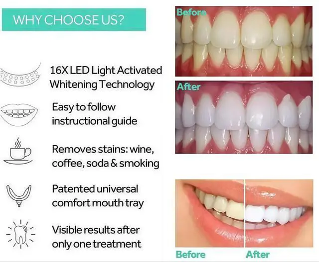 Alt view image 3 of 7 - Teeth Whitening Kit for Sensitive Teeth LED Light +| Dental-Grade Whitening (Cool Whisper)