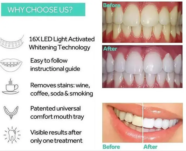 Alt view image 3 of 5 - Teeth Whitening Light with Mouth Trays- LED Powerful Accelerator Light Integrated with Smart Timer and Long Lasting Batteries