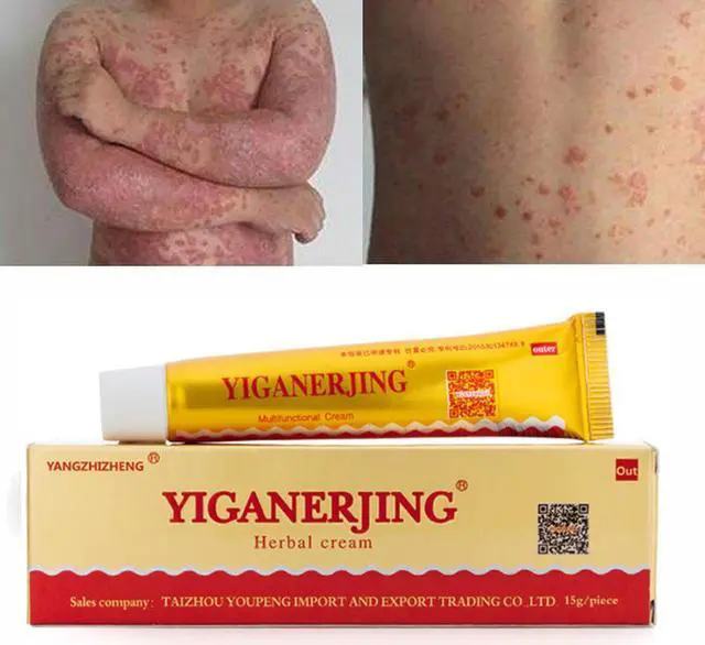 Alt view image 7 of 7 - 5PCS YIGANERJING Skin Psoriasis Cream Dermatitis Eczematoid Eczema Ointment