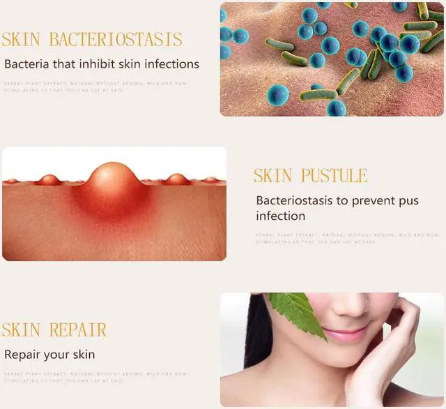 Alt view image 6 of 7 - 10 Tubes YIGANERJING Chinese Herbal Cream Skin Psoriasis Cream Dermatitis Eczematoid Eczema Ointment With Mini Soap