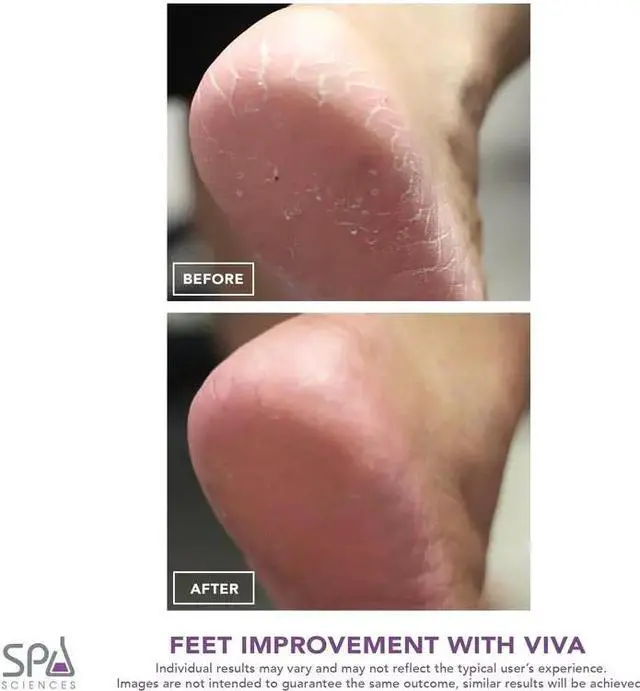 Alt view image 6 of 7 - Lairlux Powerful Pedicure Tool Electric Callus Smoother For Removing Hard, Dry, Cracked Skin/Calluses On Feet-Rechargeable, Includes 2 Grinding Heads