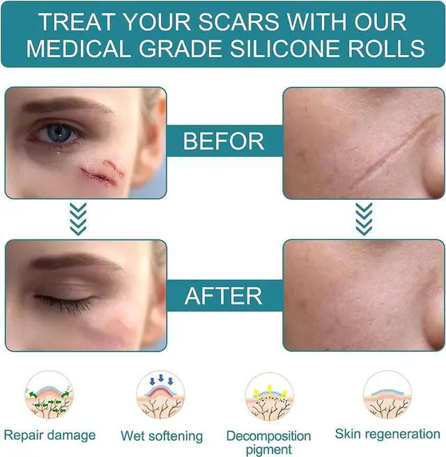 Alt view image 4 of 7 - Silicone Scar Sheets, Professional Silicone Scar Sheets,Scar Silicone Tape Strips, Scar Removal Sheets for C-Section,Surgery,Burn,Keloid,Acne (1.5 Meters(4 Month Supply)