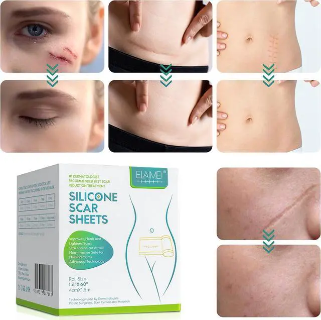 Alt view image 7 of 7 - Silicone Scar Sheets, Professional Silicone Scar Sheets,Scar Silicone Tape Strips, Scar Removal Sheets for C-Section,Surgery,Burn,Keloid,Acne (1.5 Meters(4 Month Supply)