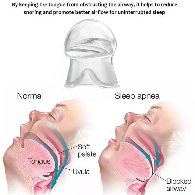 Alt view image 3 of 7 - Anti Snoring Sleep Aid Device Silicone Tongue Mouthpiece Snore Stopper With Case - Blue