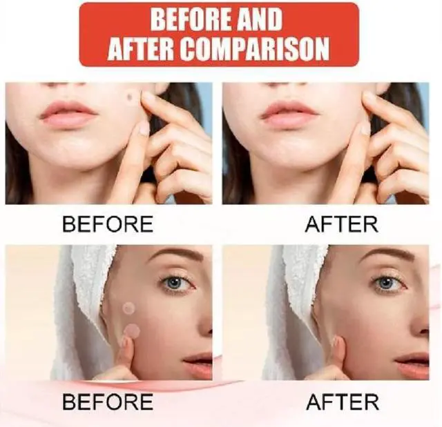 Alt view image 2 of 6 - Acne Patches Hydrocolloid Acne Pimple Patch 144 Count Spot Stickers for Face