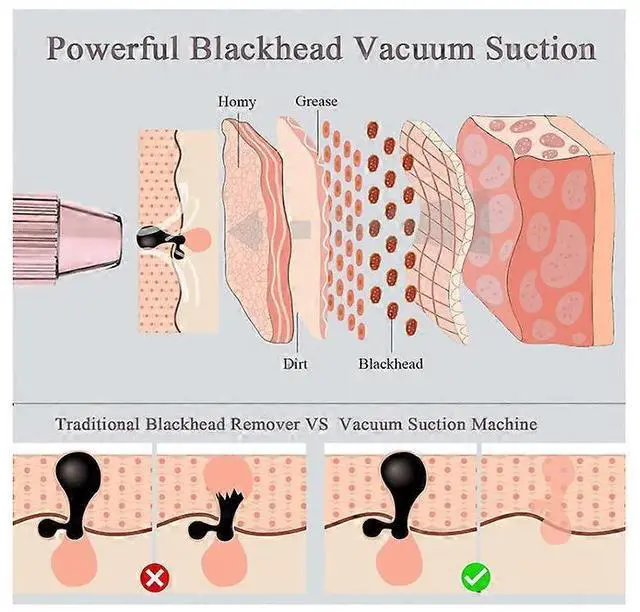 Alt view image 4 of 5 - Ecocleanpath Professional Blackhead Vacuum Remover, 5-Speed Pore Cleaner with Hot Pack & LED Screen, White