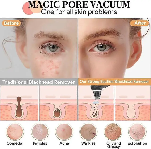 Alt view image 5 of 5 - Ecocleanpath Upgraded Blackhead Remover Pore Vacuum with Blue Light, 4 Probes & 3 Modes - Electric Facial Cleaner Tool for Women & Men - White