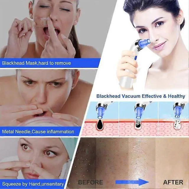 Alt view image 4 of 5 - Ecocleanpath Electric Blackhead Remover Vacuum, 5-Level Suction & 4 Probes for Deep Pore Cleaning - Rechargeable USB