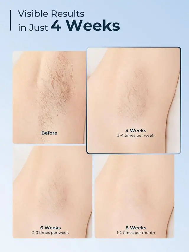 Alt view image 3 of 7 - Laser Hair Removal for Women and Men, IPL with Ice-Cooling System for Nearly Painless And Long-Lasting Result At-Home Permanent Hair Removal Device 999999 Flashes for Whole Body Use