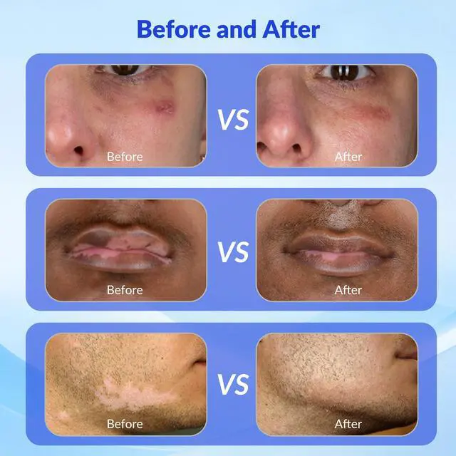 Alt view image 4 of 7 - ZJZK Excimer Laser 308nm UVB Light Therapy Device Phototherapy At Home For Psoriasis Vitiligo 20mW/cm²,0~5J/cm²  adjustable