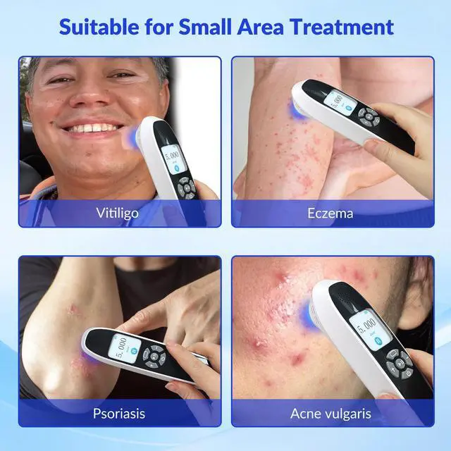 Alt view image 3 of 7 - ZJZK 308nm UVB Handheld Light Therapy Lamp High Intensity, High Targeting Phototherapy for Skin white Use for Vitiligo and Psoriasis 45mW/cm2