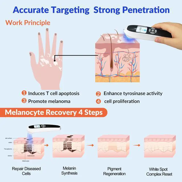 Alt view image 2 of 7 - ZJZK 308nm UVB Handheld Light Therapy Lamp High Intensity, High Targeting Phototherapy for Skin white Use for Vitiligo and Psoriasis 45mW/cm2