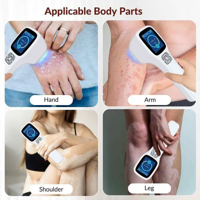 Alt view image 3 of 7 - ZJZK 308nm wavelength UVB portable handheld Lamp device, suitable for home use, safe and efficient for vitiligo psoriasis