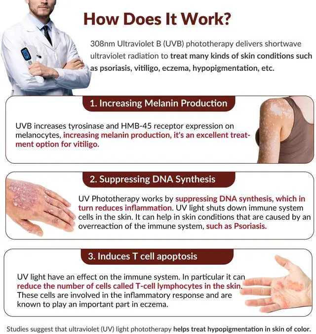 Alt view image 2 of 7 - ZJZK 308nm wavelength UVB portable handheld Lamp device, suitable for home use, safe and efficient for vitiligo psoriasis