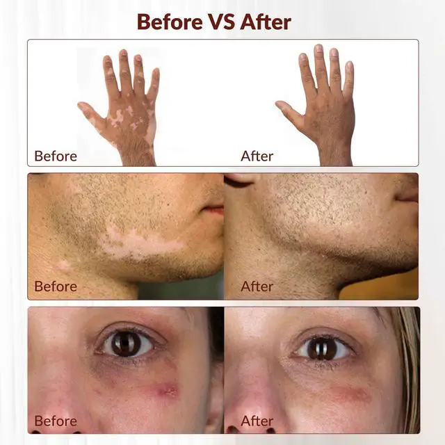 Alt view image 4 of 7 - ZJZK 308nm wavelength UVB portable handheld Lamp device, suitable for home use, safe and efficient for vitiligo psoriasis