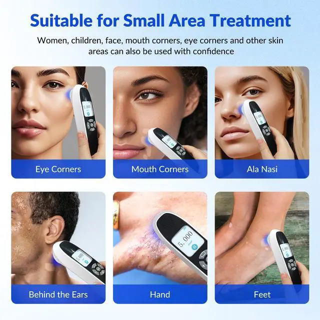 Alt view image 3 of 7 - ZJZK Excimer 308nm Laser Ultraviolet Handheld 20mW/cm² for Vitiligo, psoriasis At-Home