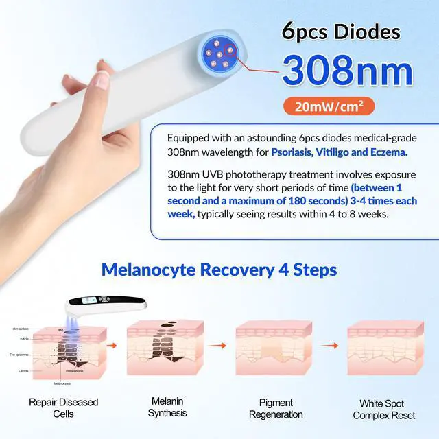 Alt view image 2 of 7 - ZJZK Excimer 308nm Laser Ultraviolet Handheld 20mW/cm² for Vitiligo, psoriasis At-Home