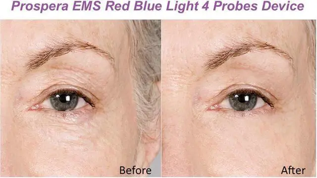Alt view image 7 of 7 - Prospera Corporation PL037 EMS Red Blue Light 4 Probes Beauty Massage Device